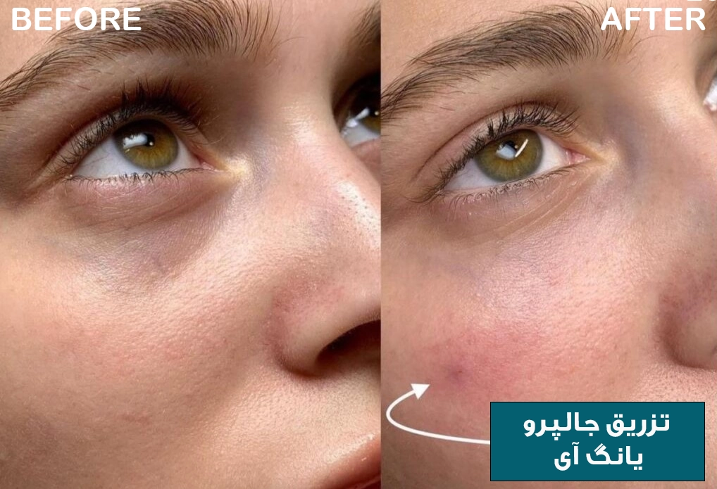 مزوژل جالپرو یانگ ای 