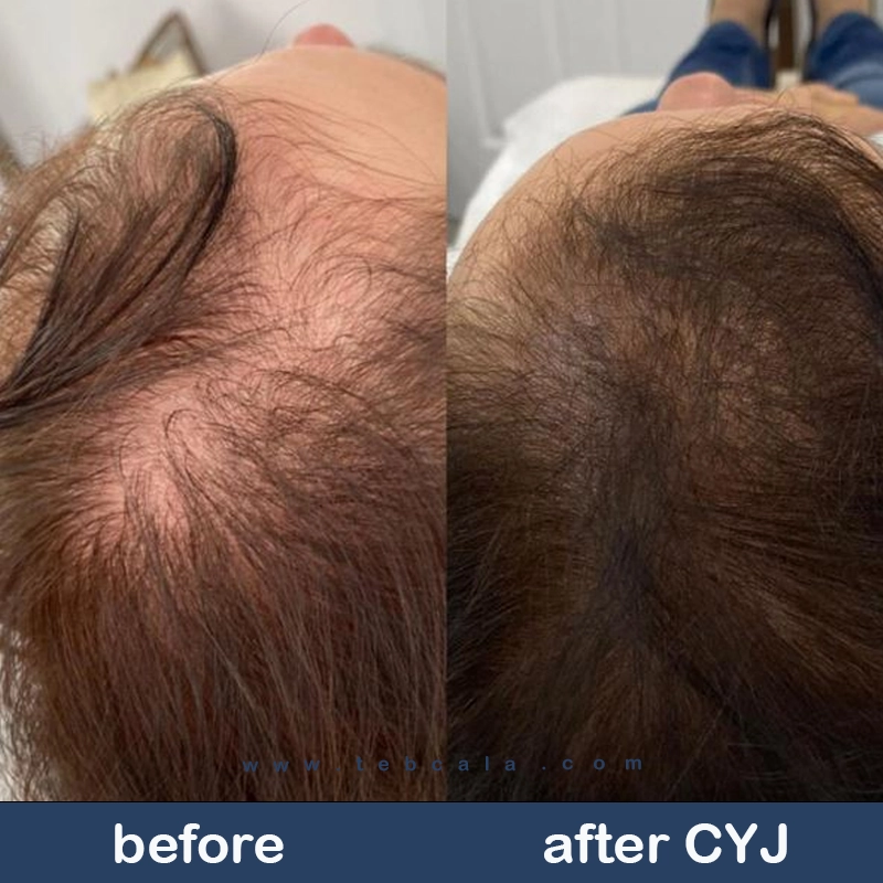 hair filler dr cyj 