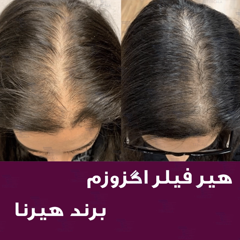 هیر فیلر هیرنا