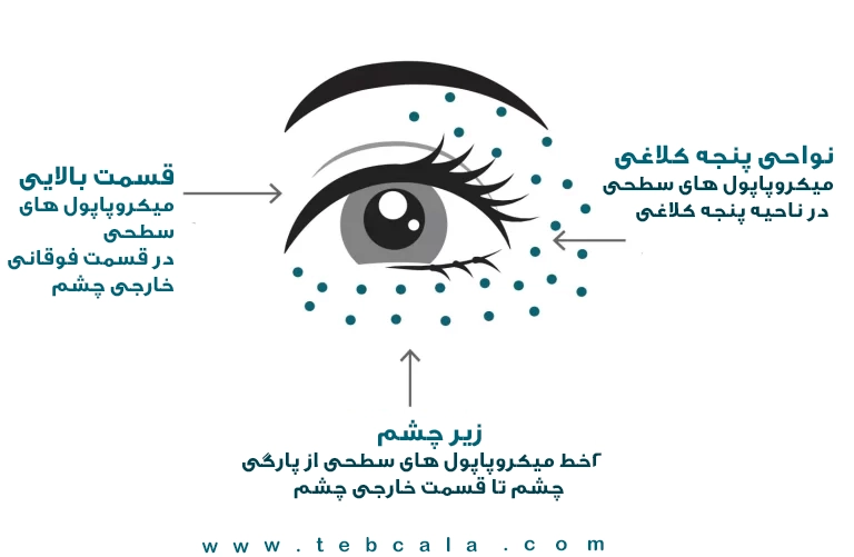 جالپرو زیر چشم 