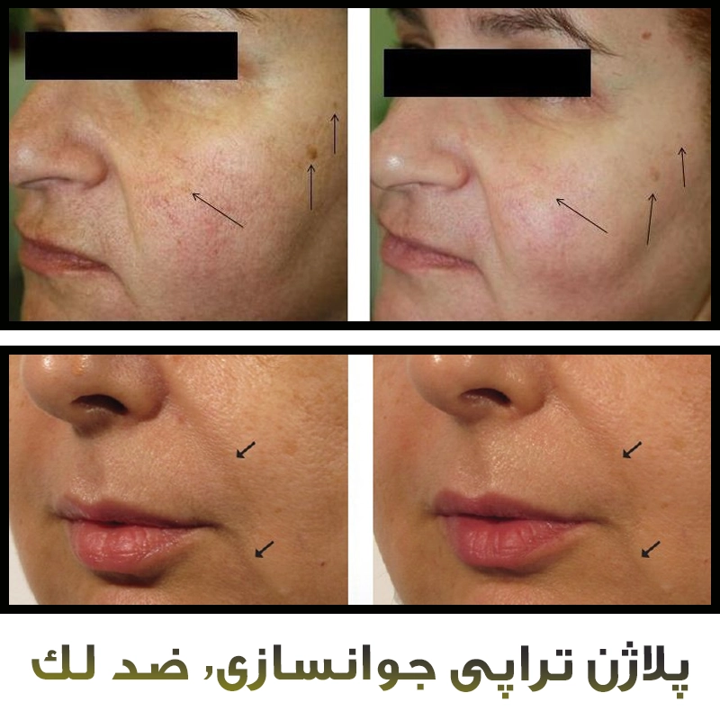 دستگاه پلاژن پرتابل
