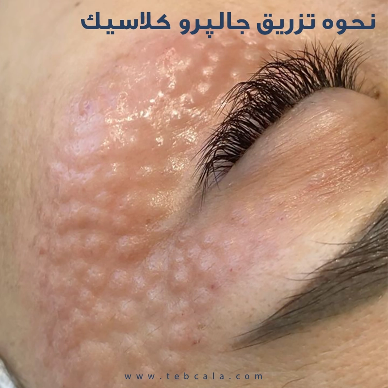 مزوژل جالپرو کلاسیک